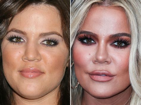 Khloé Kardashian Plastic Surgery: Before/After Nose Job Photos.